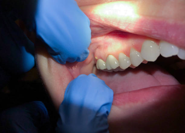 Best Dentist for Tooth Abscess  in Great River, NY